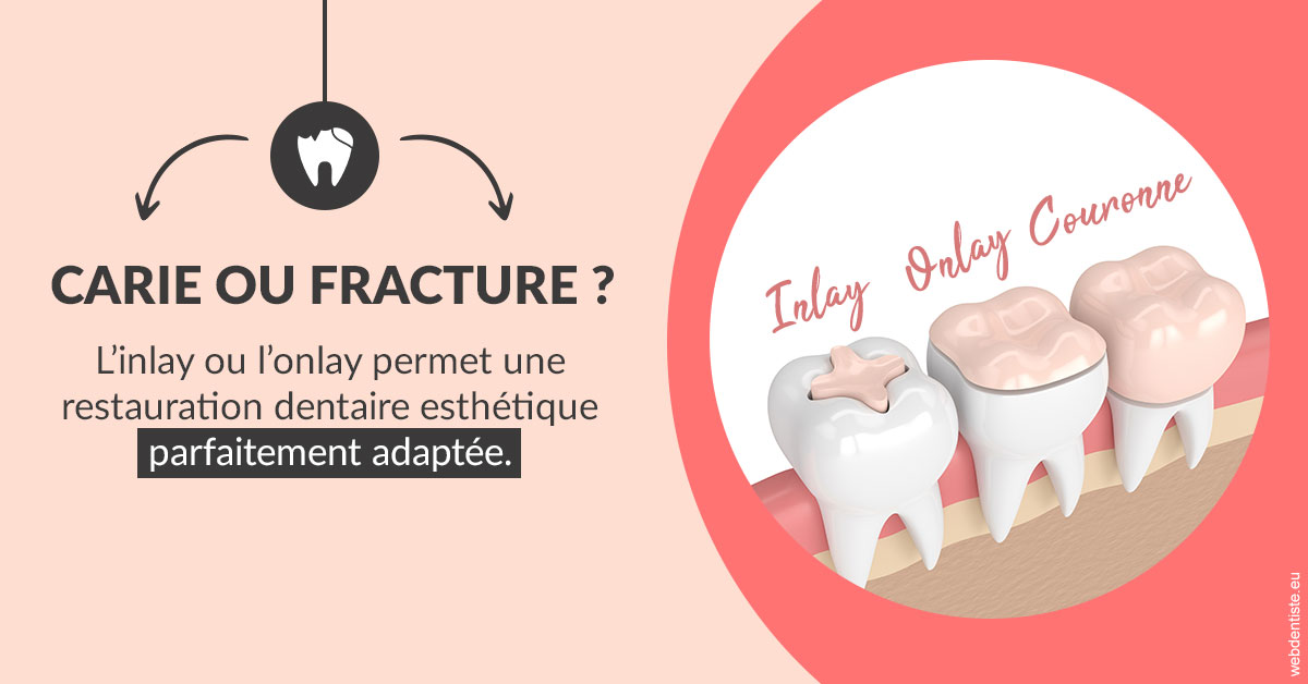https://dr-dauby-tanya.chirurgiens-dentistes.fr/T2 2023 - Carie ou fracture 2