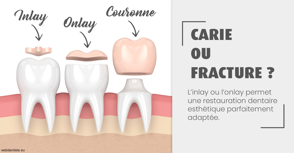 https://dr-dauby-tanya.chirurgiens-dentistes.fr/T2 2023 - Carie ou fracture 1