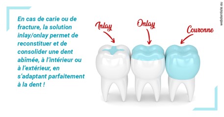 https://dr-dauby-tanya.chirurgiens-dentistes.fr/L'INLAY ou l'ONLAY