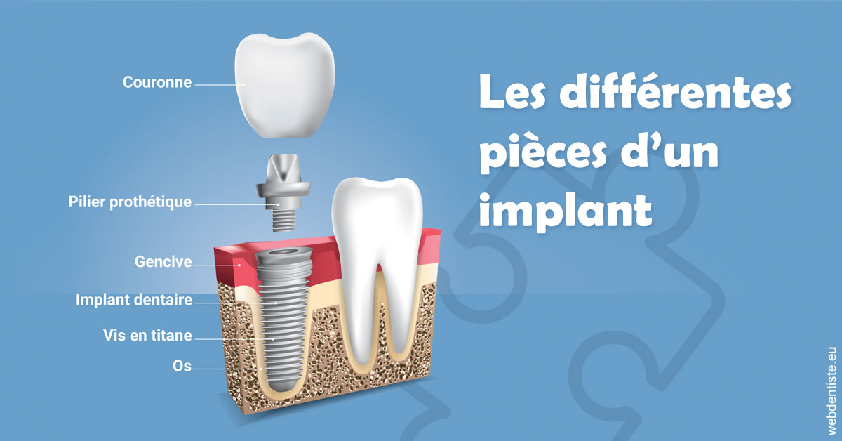 https://dr-dauby-tanya.chirurgiens-dentistes.fr/Les différentes pièces d’un implant 1